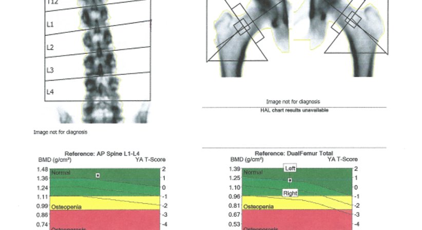 Knochendichtemessung mit TBS und FRAX - Dr. Axel Gebauer - Radiologe Baden 2500