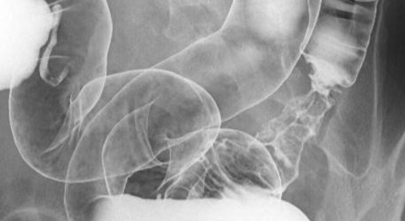 Kontrastmitteluntersuchungen von Magen, Darm, Nieren und Venen - Dr. Axel Gebauer - Radiologe Baden 2500