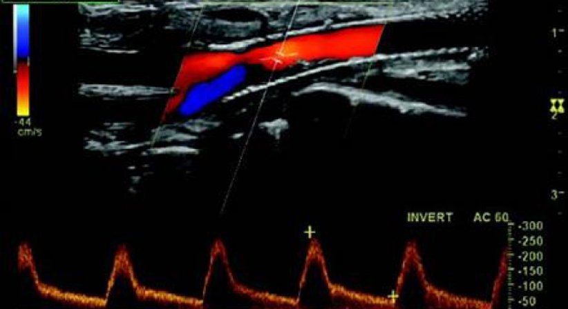 Ultraschall / Duplexsonographie - Dr. Axel Gebauer - Radiologe Baden 2500