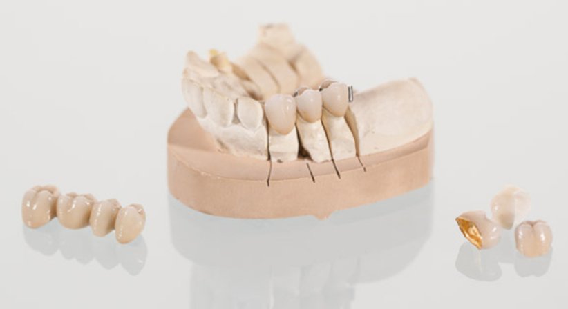 Prothetik - Dr. med. dent. Philipp Jahn, MSc. - Zahnarzt Wien 1060