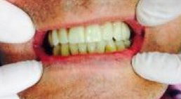 Implantate -
