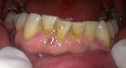 Prophylaxe -