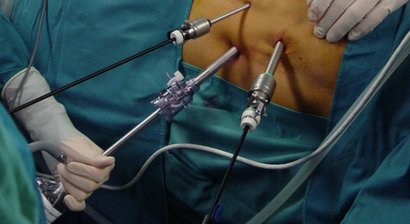 Laparoskopische Nephrektomie bei Nierenkrebs / LSK Tumorresektion