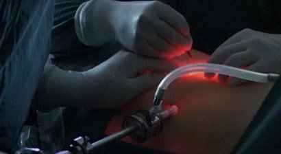 Laparoskopische Nephrektomie