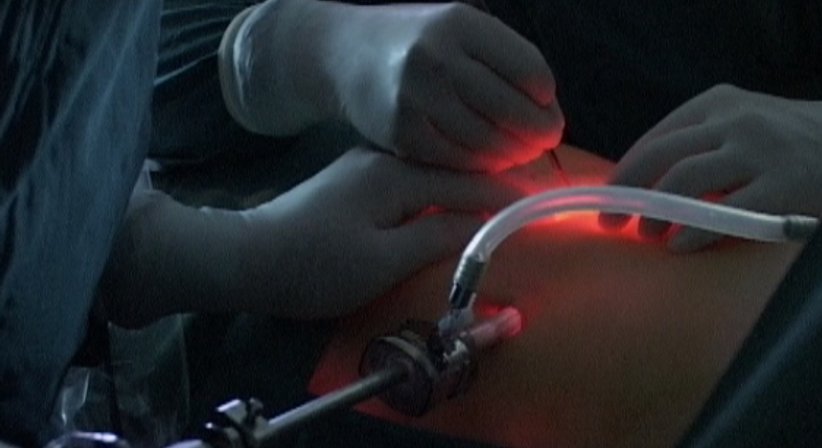 Laparoskopische Nephrektomie - Primarius Dr. Wilhelm Bauer - Urologe Wien 1190