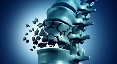 Wirbelkörperfraktur (Wirbelkörpereinbruch in Folge von Osteoporose)