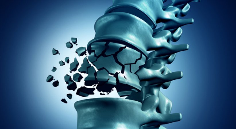 Wirbelkörperfraktur (Wirbelkörpereinbruch in Folge von Osteoporose) - OA Dr. Albert Chavanne - Orthopäde Wien 1130