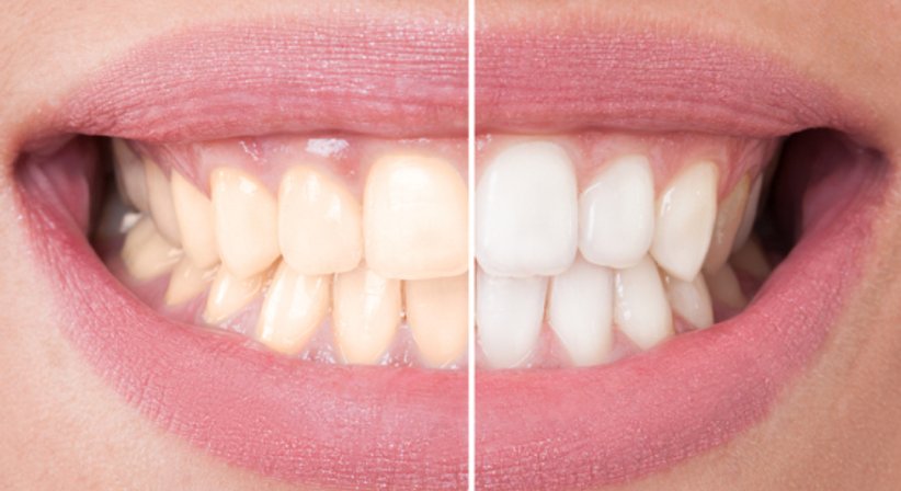 Bleaching - MR Dr. Michael Beinl - Zahnarzt Seitenstetten Markt 3353