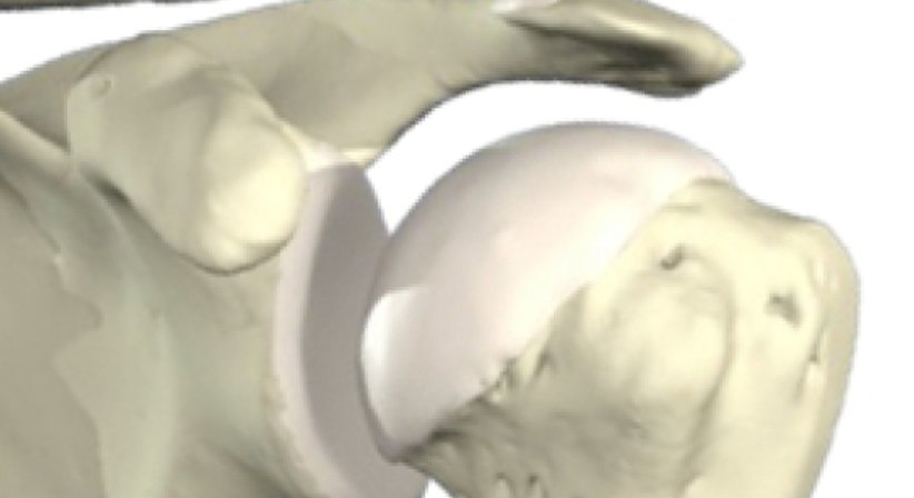 Schulterchirurgie - Dr. Richard Malousek - Orthopäde Wien 1010