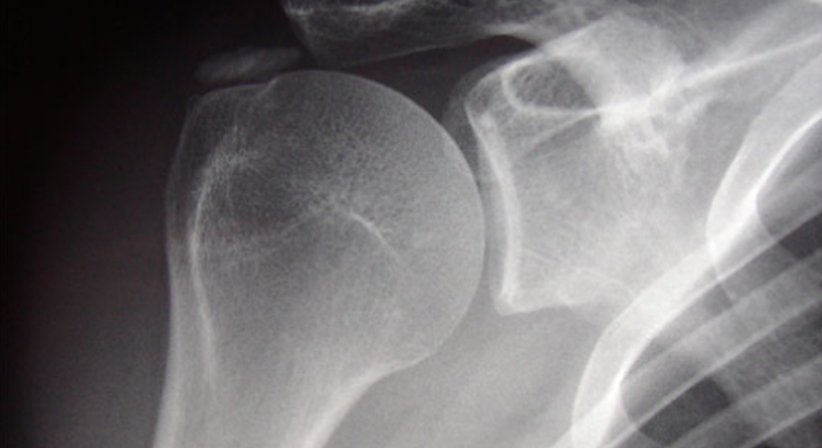 Schulterchirurgie - Dr. Richard Malousek - Orthopäde Wien 1010