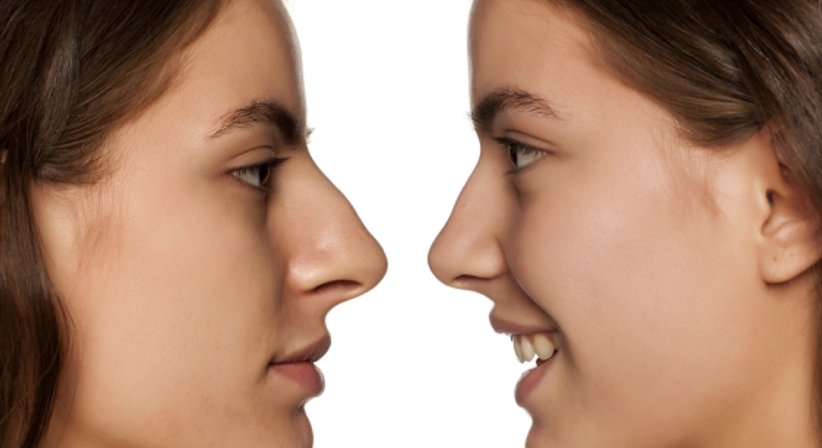 Nasenkorrekturen - DDr. Hubert Ofner - Kieferchirurg Wien 1190