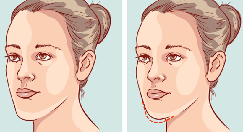 Profilkorrekturen - DDr. Hubert Ofner - Kieferchirurg Wien 1190