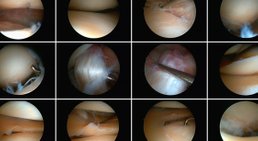 Arthroskopie -