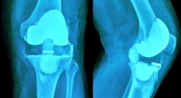 Knietotalendoprothese -