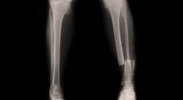 Knochenbruchbehandlungen -