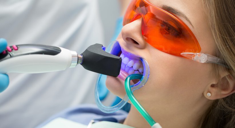 Bleaching  - Dr. Walter Neunteufel, MSc - Zahnarzt Tulln an der Donau 3430