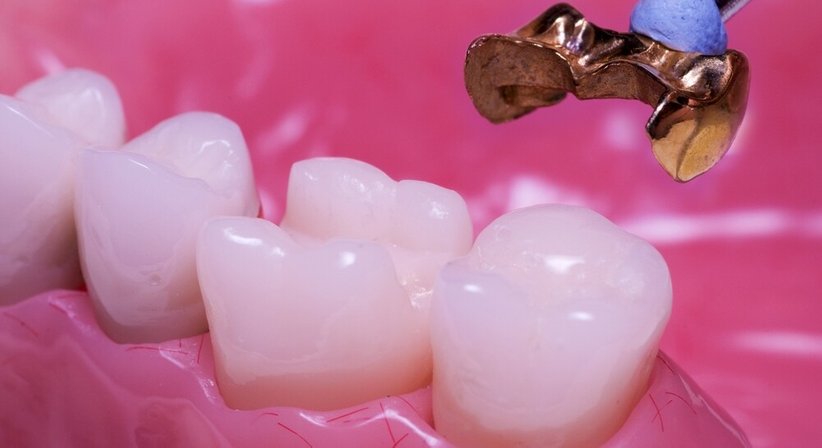 Kronen und Brücken  - Dr. Walter Neunteufel, MSc - Zahnarzt Tulln an der Donau 3430