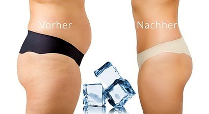 Kryolipolyse (Fett wegfrieren)
