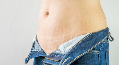 Behandlung von Narben und Dehnungsstreifen