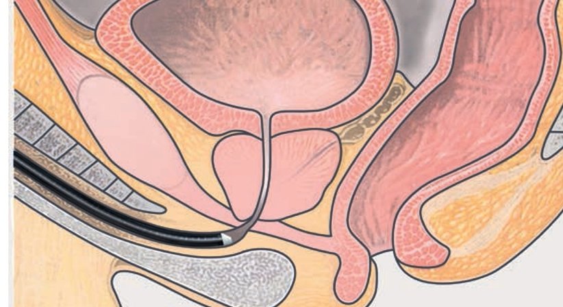 Blasenspiegelung - OA Dr. Oleg Kheyfets, F.E.B.U. - Urologe Wien 1010