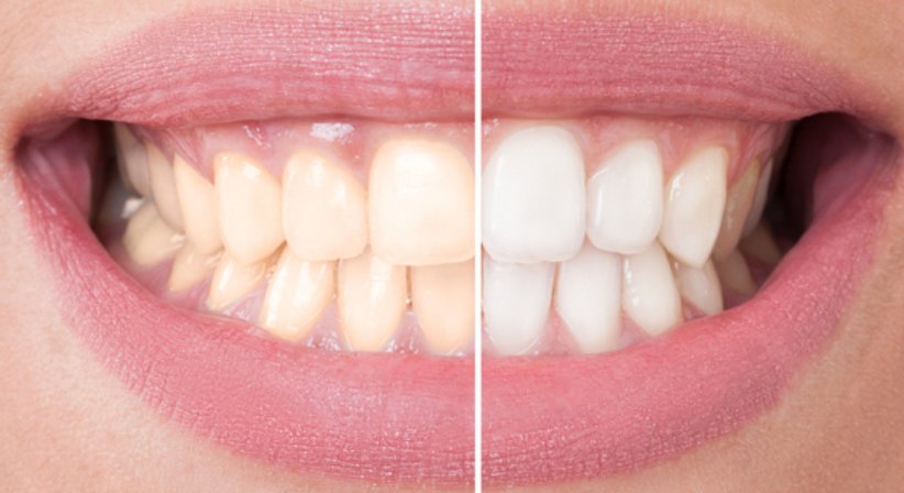 Bleaching - Dr. Stefan Schragl - Zahnarzt Neunkirchen 2620