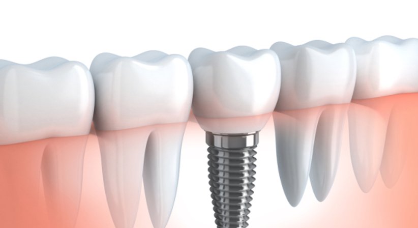Implantologie - Dr. Stefan Schragl - Zahnarzt Neunkirchen 2620