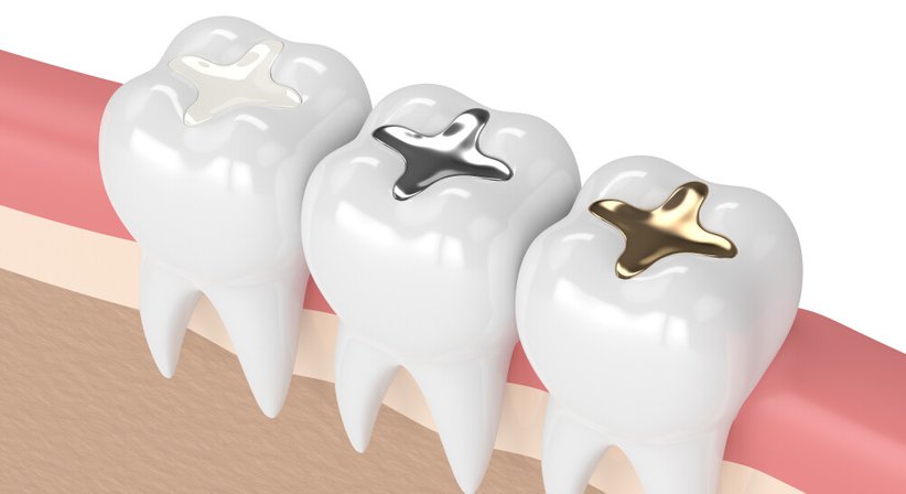 Zahnerhaltung / Mikroskopunterstützte Zahnbehandlung - Dr. med. dent. Kremena Malinova - Zahnärztin Wien 1060