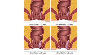 Hämorrhoiden