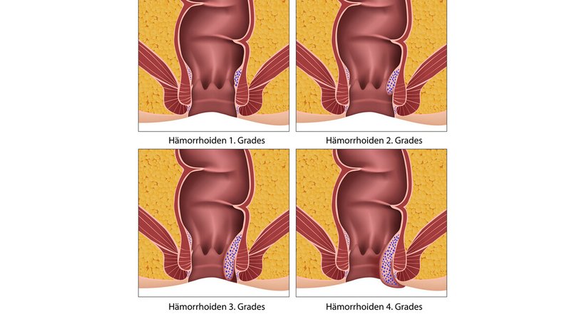 Hämorrhoiden - OA Dr. med. univ. Alexander Di Monte - Allgemeinchirurg/Viszeralchirurg Wien 1090