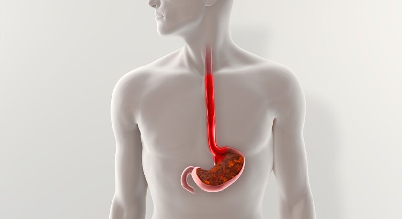 Reflux (Refluxkrankheit) - OA Dr. med. univ. Alexander Di Monte - Allgemeinchirurg/Viszeralchirurg Wien 1090