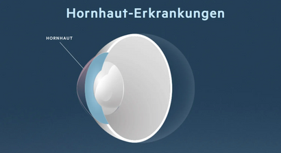 Hornhaut-Erkrankungen
