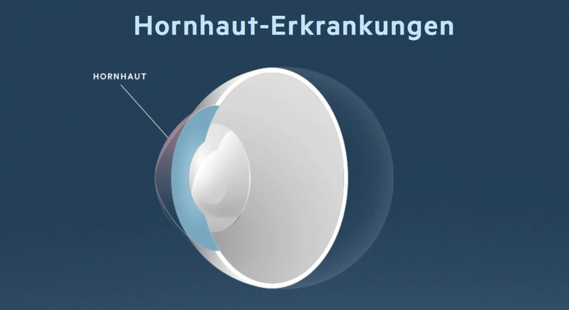 Hornhaut-Erkrankungen - Prof. Dr. Martin Dirisamer, FEBO - Augenarzt Wien 1010