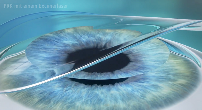 PRK (LASEK) - Prof. Dr. Martin Dirisamer, FEBO - Augenarzt Wien 1010