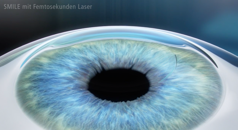 Relex SMILE - Prof. Dr. Martin Dirisamer, FEBO - Augenarzt Wien 1010