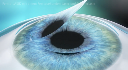Femtosekunden-LASIK