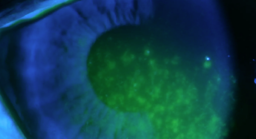 Trockenes Auge - Prof. Dr. Martin Dirisamer, FEBO - Augenarzt Wien 1010