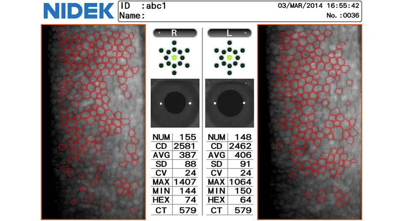 Hornhaut-Erkrankungen - Prof. Dr. Martin Dirisamer, FEBO - Augenarzt Wien 1010