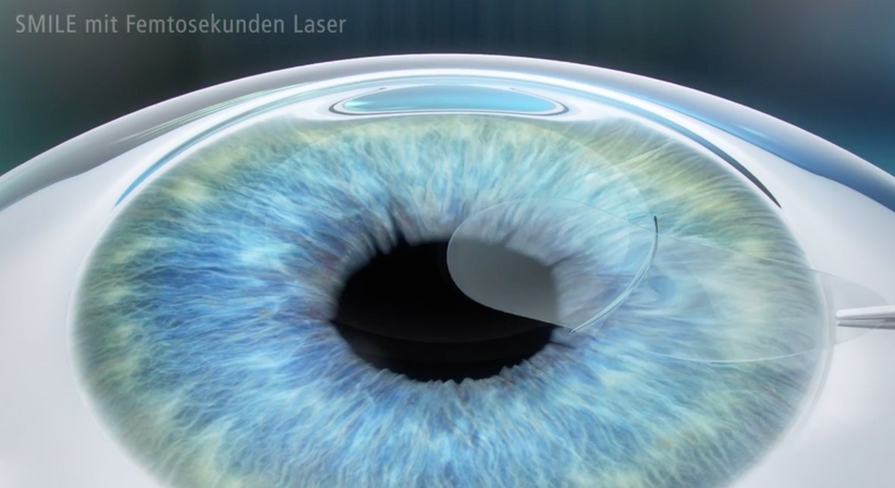 Relex SMILE - Prof. Dr. Martin Dirisamer, FEBO - Augenarzt Wien 1010