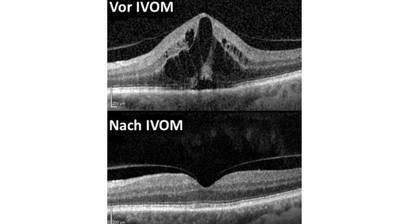 IVOM (Intravitreale Medikamenteneingabe)