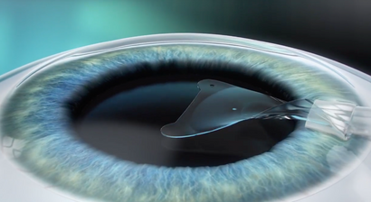 ICL – Implantierbare Collamer Linse