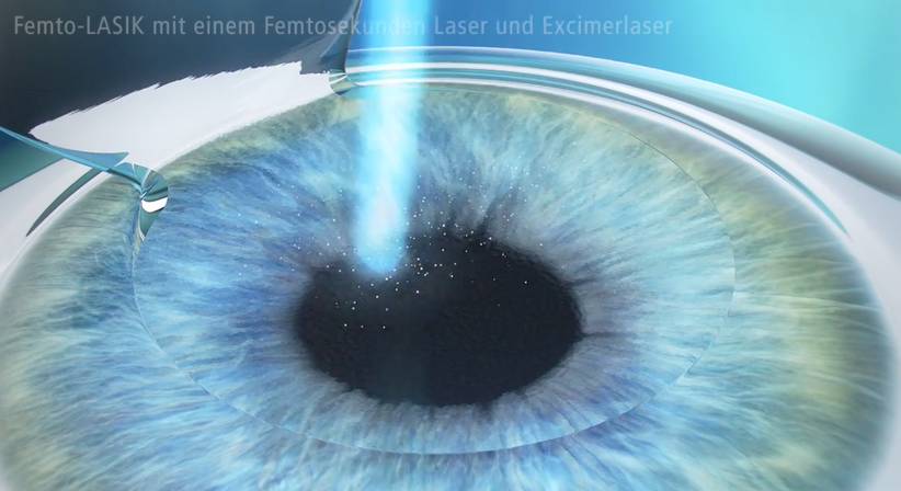 Femtosekunden-LASIK - Prof. Dr. Martin Dirisamer, FEBO - Augenarzt Wien 1010