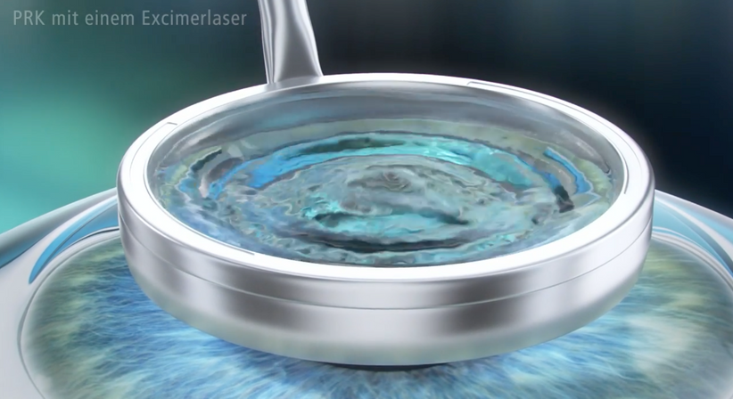 PRK (LASEK) - Prof. Dr. Martin Dirisamer, FEBO - Augenarzt Wien 1010