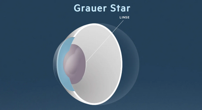 Grauer Star (Katarakt)