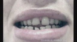 Veneers -