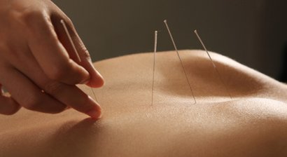 Akupunktur