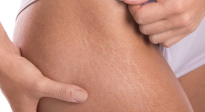 Dehnungsstreifen, Schwangerschaftsstreifen