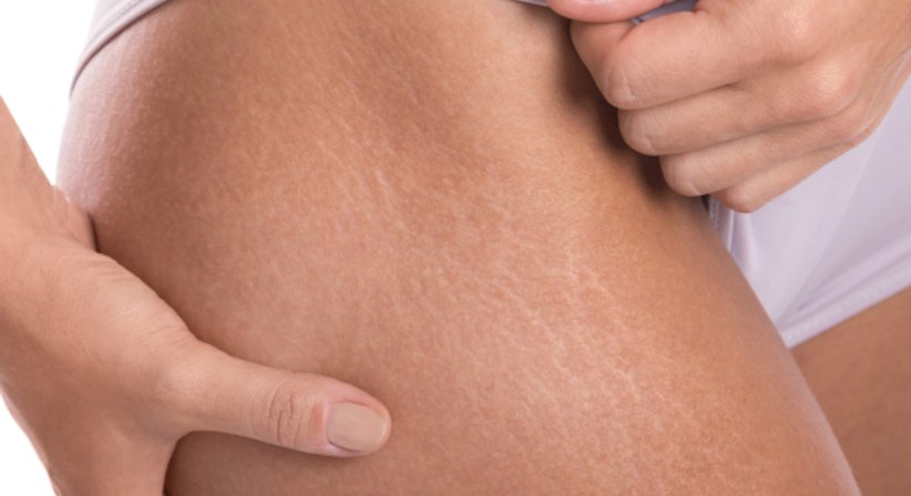 Dehnungsstreifen, Schwangerschaftsstreifen - OA Dr. Frank Marschall - Allgemeinchirurg/Viszeralchirurg Wien 1090