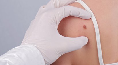 Lipom, Atherom entfernen durch sanftes Laserlicht