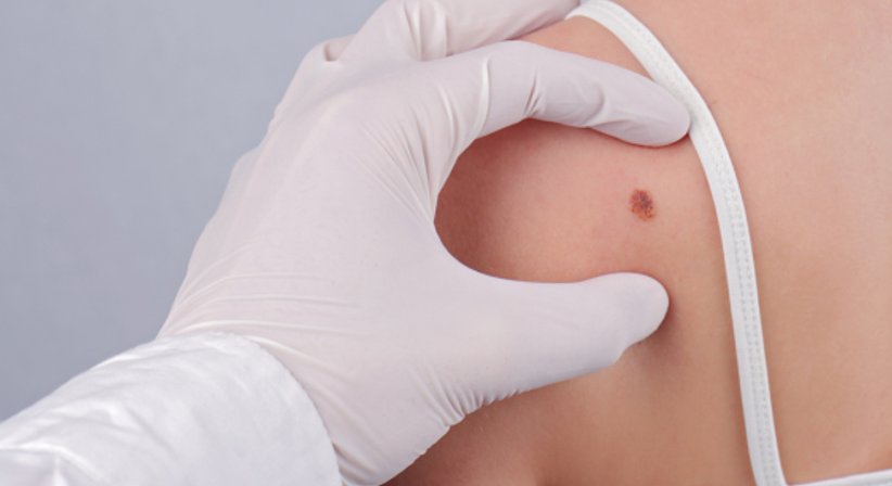 Lipom, Atherom entfernen durch sanftes Laserlicht - OA Dr. Frank Marschall - Allgemeinchirurg/Viszeralchirurg Wien 1090