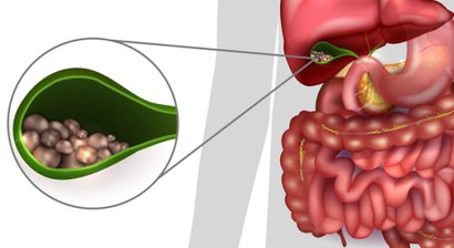 Gallenblasenentfernung, Gallenkolik, Gallensteine (Cholezystektomie)